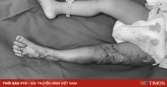 Giữ đôi chân cho bé trai bị rắn hổ mang cắn