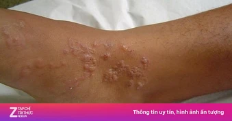 Giun chi chít, gồ ghề dưới da suốt 2 năm nhưng không hay biết