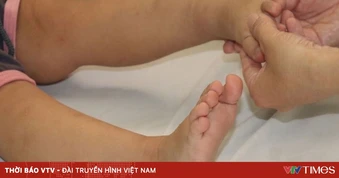 Hà Nội: Số ca mắc tay chân miệng tiếp tục tăng