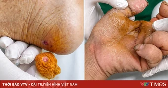 Hai người nguy kịch vì uốn ván sau khi bị... gà mổ, ngã xe