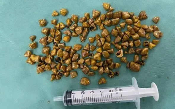 Hàng trăm viên sỏi trong túi mật người bệnh 39 tuổi Hàng trăm viên sỏi trong túi mật người bệnh 39 tuổi