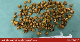 Hàng trăm viên sỏi trong túi mật người bệnh 39 tuổi