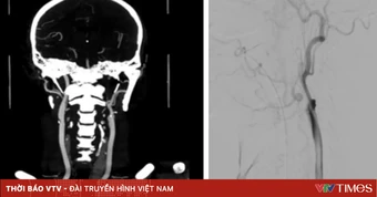 Hiếm gặp: Bệnh nhân đồng thời đột quỵ tim - não