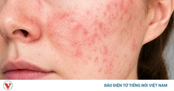 Hiểm họa khi tự ý lạm dụng thuốc, mỹ phẩm chứa corticoid