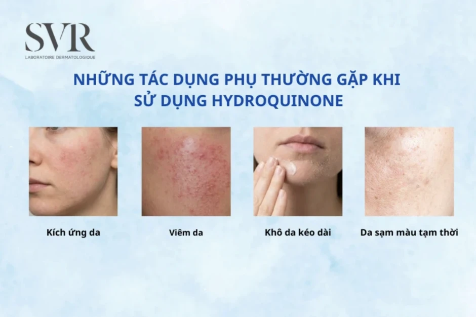 Hiệu quả tức thì của Hydroquinone: Khi "tốc độ" chưa chắc đồng hành cùng "sức khỏe" làn da Hiệu quả tức thì của Hydroquinone: Khi "tốc độ" chưa chắc đồng hành cùng "sức khỏe" làn da