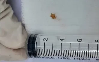 Ho hơn một tháng vì mẩu xương lươn mắc trong phế quản Ho hơn một tháng vì mẩu xương lươn mắc trong phế quản