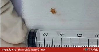 Ho hơn một tháng vì mẩu xương lươn mắc trong phế quản