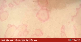 Hơn 20 năm tự điều trị mày đay, người phụ nữ đối mặt nhiều biến chứng