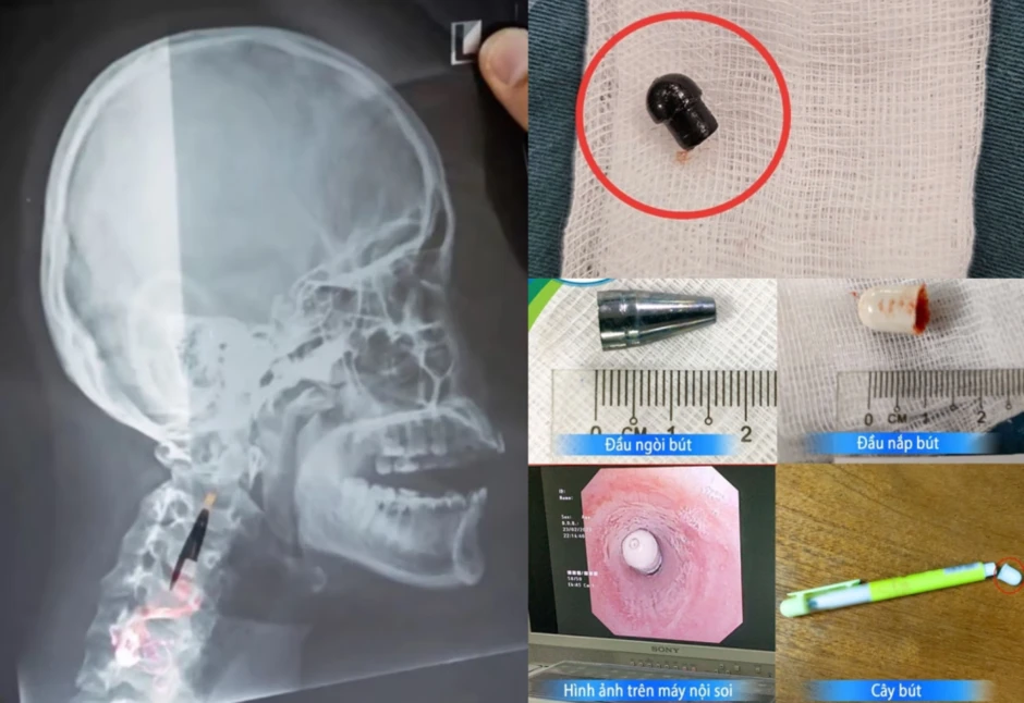 Hơn 90% người dùng không biết chiếc lỗ nhỏ trên nắp bút bi dùng để làm gì! Hơn 90% người dùng không biết chiếc lỗ nhỏ trên nắp bút bi dùng để làm gì!