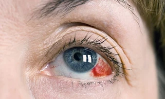 Hôn mê, vỡ mạch máu võng mạc sau chuỗi ngày thức đêm ăn vặt