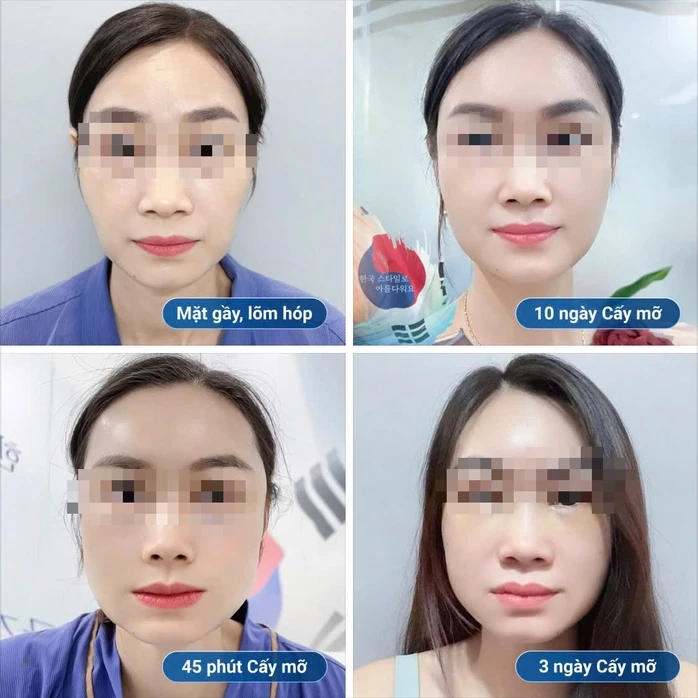 Hóp má, teo mô sau thẩm mỹ: Biến chứng “âm thầm” nhưng nguy hiểm Hóp má, teo mô sau thẩm mỹ: Biến chứng “âm thầm” nhưng nguy hiểm