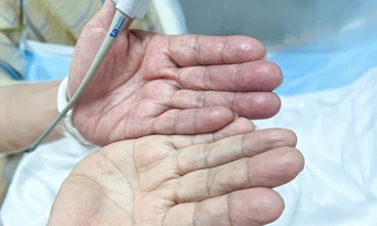 Huyết khối gây tắc động mạch cánh tay do bỏ thuốc chữa rung nhĩ - Báo TinVina