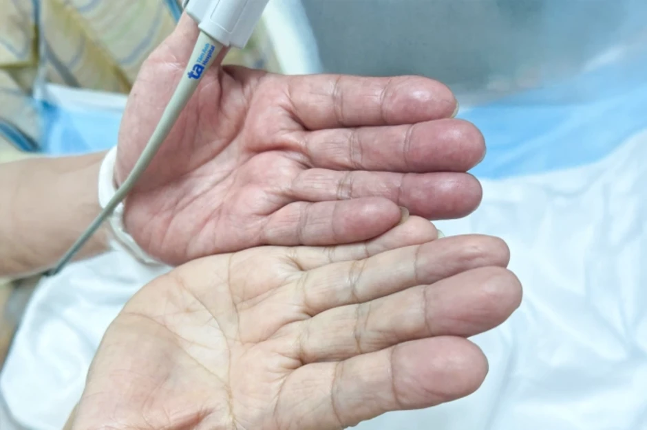 Huyết khối gây tắc động mạch cánh tay do bỏ thuốc chữa rung nhĩ - Báo TinVina Huyết khối gây tắc động mạch cánh tay do bỏ thuốc chữa rung nhĩ - Báo TinVina