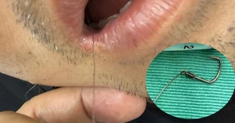 Hy hữu: Người đàn ông bị lưỡi câu mắc sâu trong thực quản khi ăn cá