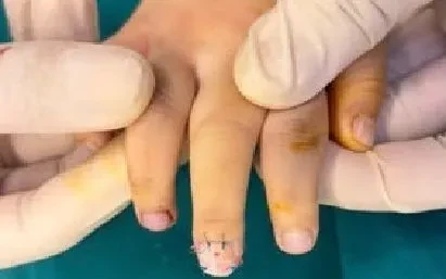 Kẹp cửa - tai nạn thường gặp gây chấn thương đầu ngón tay trẻ nhỏ Kẹp cửa - tai nạn thường gặp gây chấn thương đầu ngón tay trẻ nhỏ