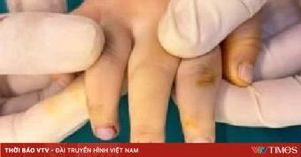 Kẹp cửa - tai nạn thường gặp gây chấn thương đầu ngón tay trẻ nhỏ