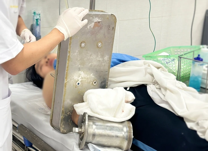 Kẹt nguyên bàn tay trong máy xay thịt, người phụ nữ phải phẫu thuật cắt cụt chi Kẹt nguyên bàn tay trong máy xay thịt, người phụ nữ phải phẫu thuật cắt cụt chi