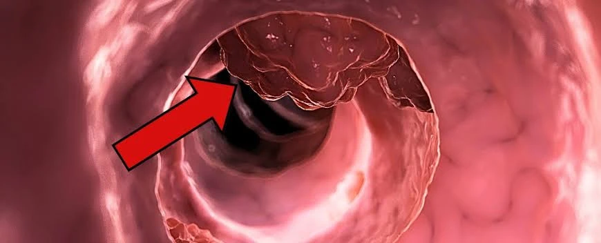 Khảo sát 522 người tử vong vì ung thư đại trực tràng phát hiện 3 điểm chung đáng chú ý
