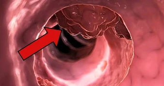 Khảo sát 522 người tử vong vì ung thư đại trực tràng phát hiện 3 điểm chung đáng chú ý