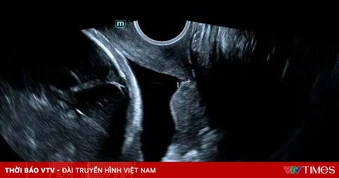 Khâu vòng cổ tử cung cứu thai phụ có dị dạng hiếm