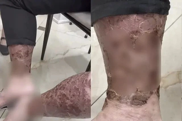 Khổ sở vì ngứa, thanh niên phải dùng rượu làm "thuốc ngủ" Khổ sở vì ngứa, thanh niên phải dùng rượu làm "thuốc ngủ"