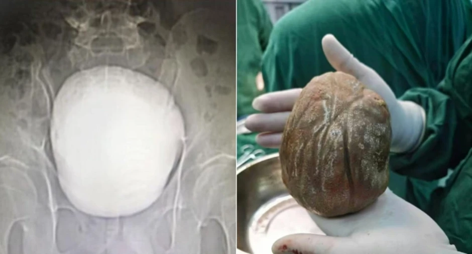 Khối sỏi bàng quang 1,3 kg khiến người đàn ông tiểu buốt suốt 3 năm Khối sỏi bàng quang 1,3 kg khiến người đàn ông tiểu buốt suốt 3 năm