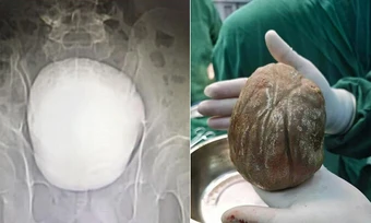 Khối sỏi bàng quang 1,3 kg khiến người đàn ông tiểu buốt suốt 3 năm