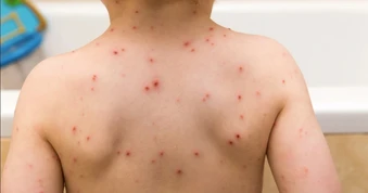 Khỏi thủy đậu vẫn chưa hết nguy cơ, virus có thể "ngủ đông" gây bệnh zona