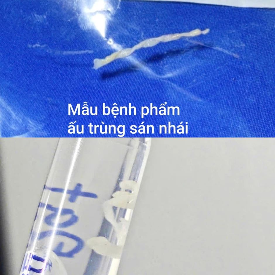 Khối u dưới da hé lộ bệnh ký sinh trùng hiếm gặp sau lần tắm suối Khối u dưới da hé lộ bệnh ký sinh trùng hiếm gặp sau lần tắm suối