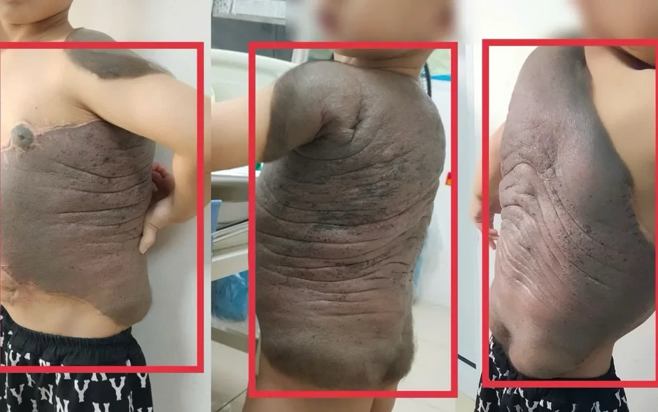 Khối u như "mai rùa" đeo bám bé trai suốt 7 năm Khối u như "mai rùa" đeo bám bé trai suốt 7 năm