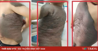 Khối u như "mai rùa" đeo bám bé trai suốt 7 năm