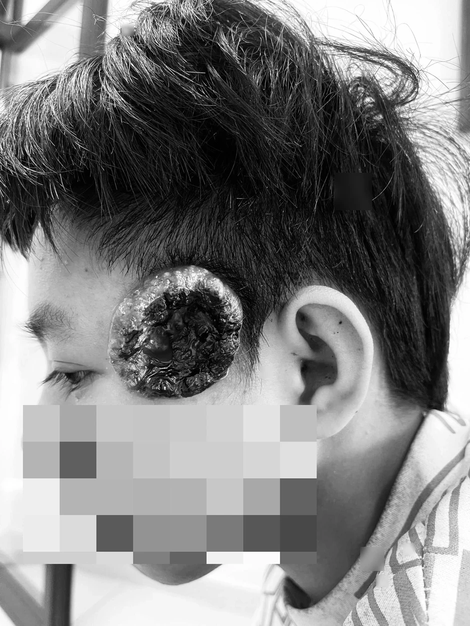 Khối u thái dương vỡ loét, thiếu niên 16 tuổi phát hiện ung thư da Khối u thái dương vỡ loét, thiếu niên 16 tuổi phát hiện ung thư da