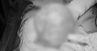 Khối u tương đương quả bưởi khiến người phụ nữ đau bụng bất thường