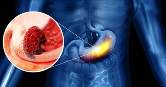 Không chỉ rượu bia, ung thư dạ dày thường "để mắt” tới những người thường xuyên sử dụng loại đồ uống này