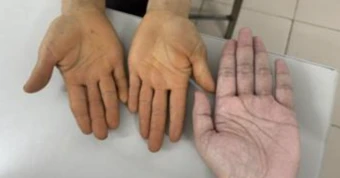 Không mắc bệnh về gan, tại sao lòng bàn tay, bàn chân chuyển màu vàng?