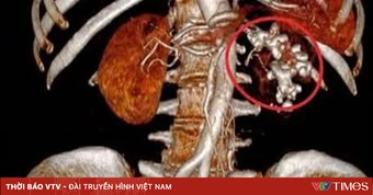 Không sử dụng thuốc nam để điều trị sỏi thận