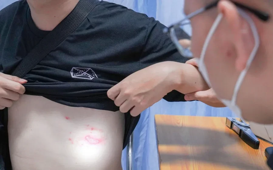 Kiến ba khoang gây viêm da, dễ bội nhiễm nếu xử trí sai Kiến ba khoang gây viêm da, dễ bội nhiễm nếu xử trí sai