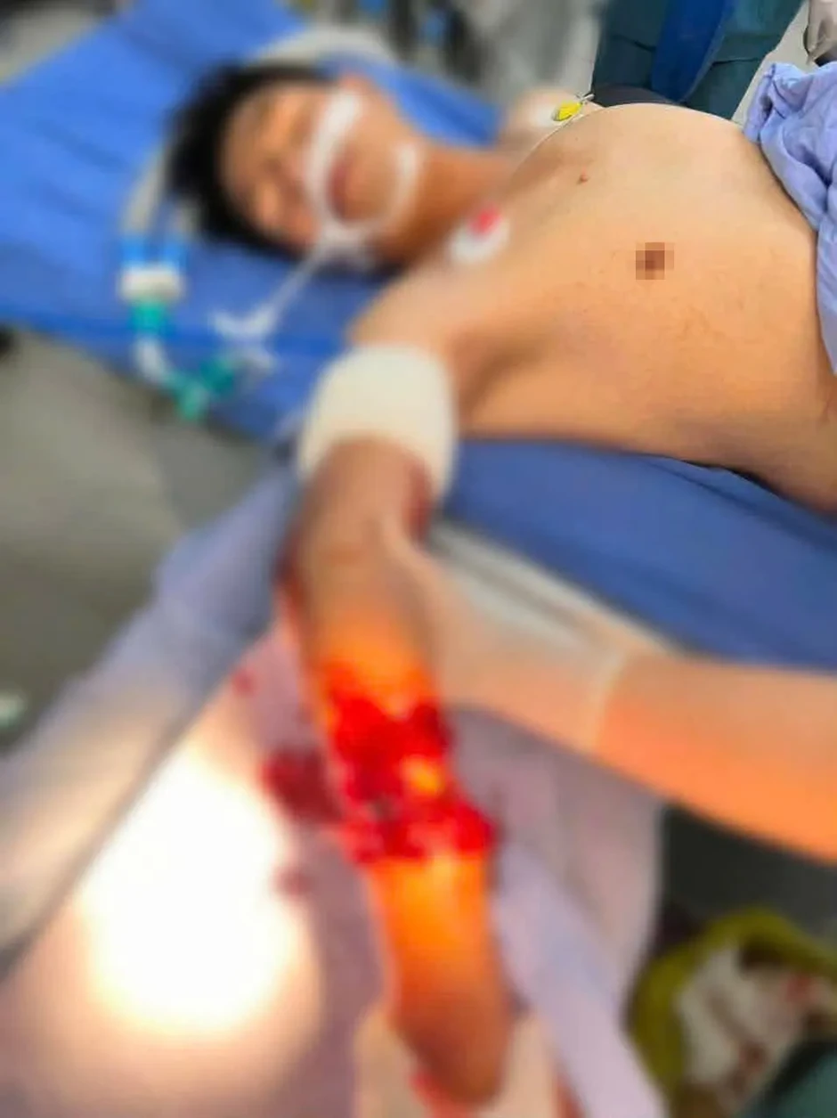 Lâm Đồng: Nối thành công cánh tay đứt gần lìa do máy nghiền đá Lâm Đồng: Nối thành công cánh tay đứt gần lìa do máy nghiền đá