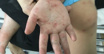 Làm gì để giảm nguy cơ tử vong và di chứng do bệnh tay chân miệng?