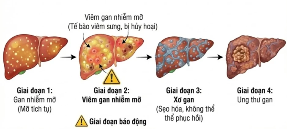 Lầm tưởng 'chết người' về gan nhiễm mỡ