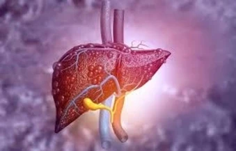 Lầm tưởng 'chết người' về gan nhiễm mỡ