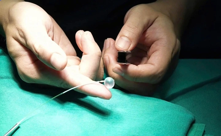 Lần đầu tại Việt Nam: Đặt bóng vào khí quản cứu thai nhi mắc thoát vị hoành Lần đầu tại Việt Nam: Đặt bóng vào khí quản cứu thai nhi mắc thoát vị hoành