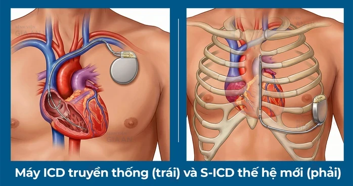 Lần đầu tiên đặt máy phá rung tim công nghệ mới Lần đầu tiên đặt máy phá rung tim công nghệ mới