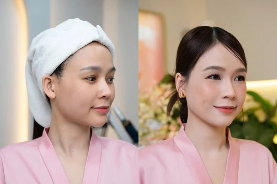 Lavish Clinic - By Huyền Baby cập nhật kỹ thuật khắc phục sắc tố Lavish Clinic - By Huyền Baby cập nhật kỹ thuật khắc phục sắc tố