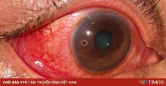 Lấy dị vật giác mạc sâu trong mắt bệnh nhân