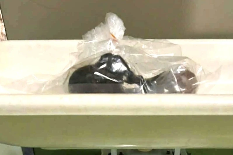 Lấy khối tóc 0,25kg trong đường tiêu hóa của bé gái 5 tuổi Lấy khối tóc 0,25kg trong đường tiêu hóa của bé gái 5 tuổi