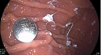 Liên tiếp ca nuốt dị vật: Xương gà găm thực quản, trẻ nuốt pin cúc áo