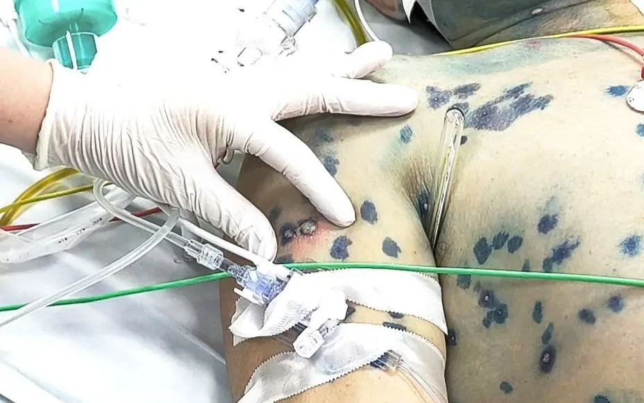 Liên tiếp các ca bệnh người trưởng thành mắc thủy đậu diễn tiến nặng Liên tiếp các ca bệnh người trưởng thành mắc thủy đậu diễn tiến nặng