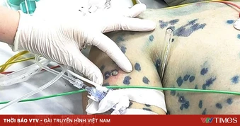 Liên tiếp các ca bệnh người trưởng thành mắc thủy đậu diễn tiến nặng