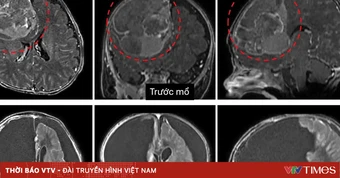 Loại bỏ khối u não ác tính cho bé 2 tháng tuổi